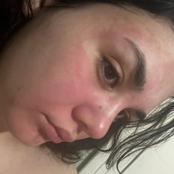 Isana Peeling Ürünü Ciltte Yanma Ve Kızarıklık Yaptı