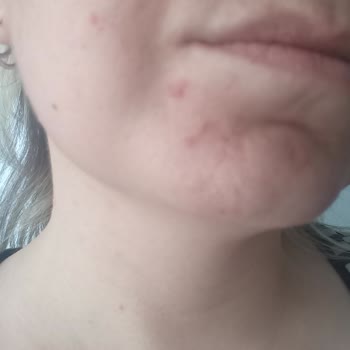 Duaderm Ürünleri Cildimi Mahvetti