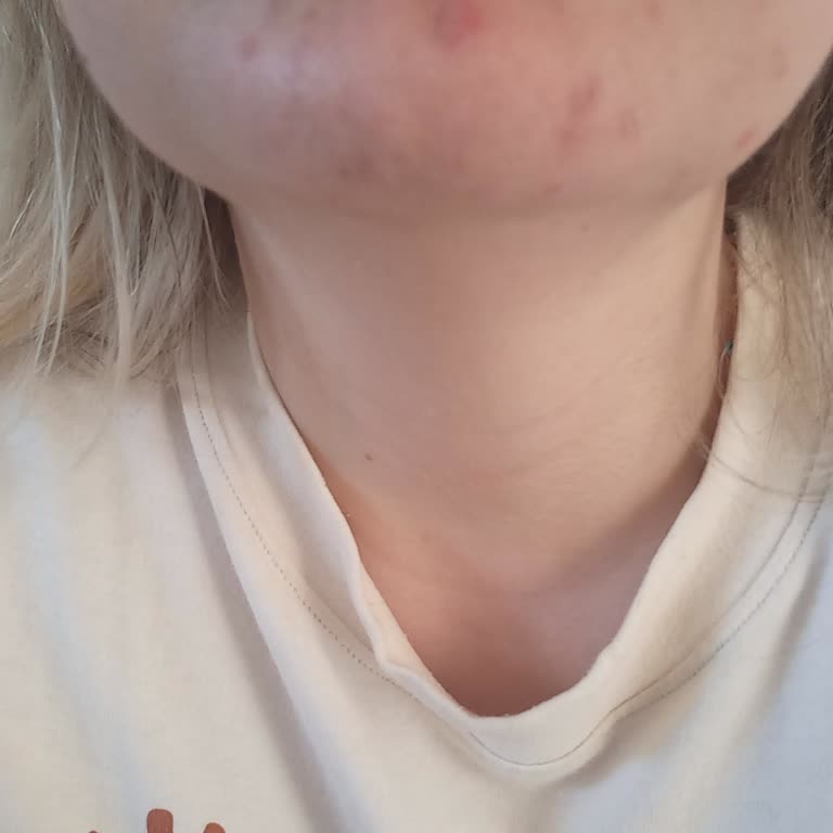 Duaderm Ürünleri Cildimi Mahvetti