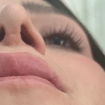 Rinoplasti Sonrası Hayal Kırıklığı Ve Mağduriyet