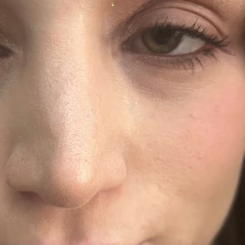 Rinoplasti Sonrası Hayal Kırıklığı Ve Mağduriyet