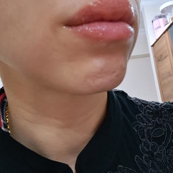 Aldığım Ruj Dudaklarımda Alerji Yaptı