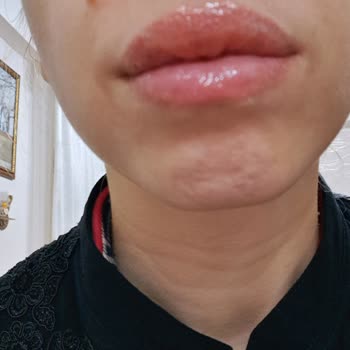 Aldığım Ruj Dudaklarımda Alerji Yaptı