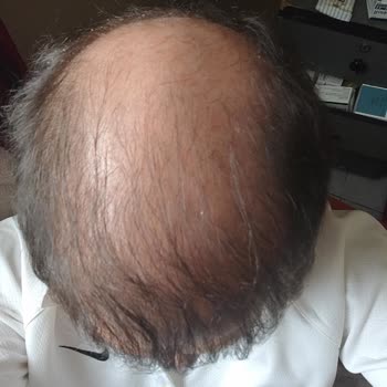 Saç Ekiminde Hayal Kırıklığı: Clinichair