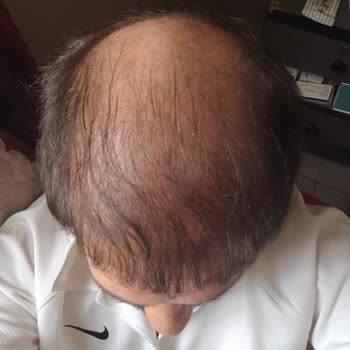 Saç Ekiminde Hayal Kırıklığı: Clinichair