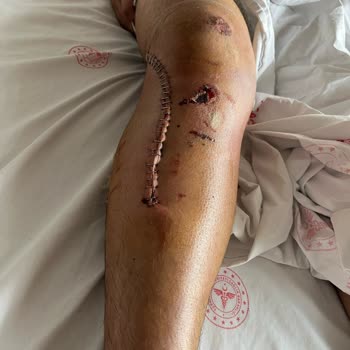 Onvo Scooter İle Yaşanan Güvenlik Sorunu