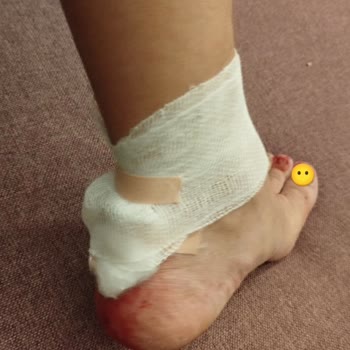 Gönen Hotels Otelin İhmalkarlığı Sonucu Yaralandım Destek Alamadım