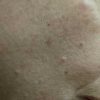 La Roche Posay Güneş Kremi Cilt Sorunlarına Yol Açtı