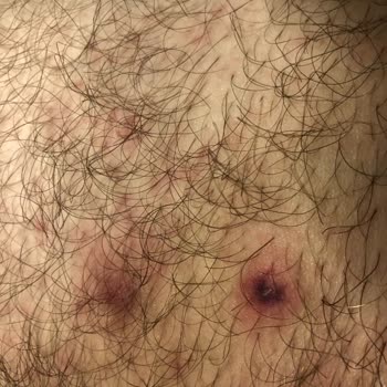 Зуд и сыпь после использования Persil Power Gel