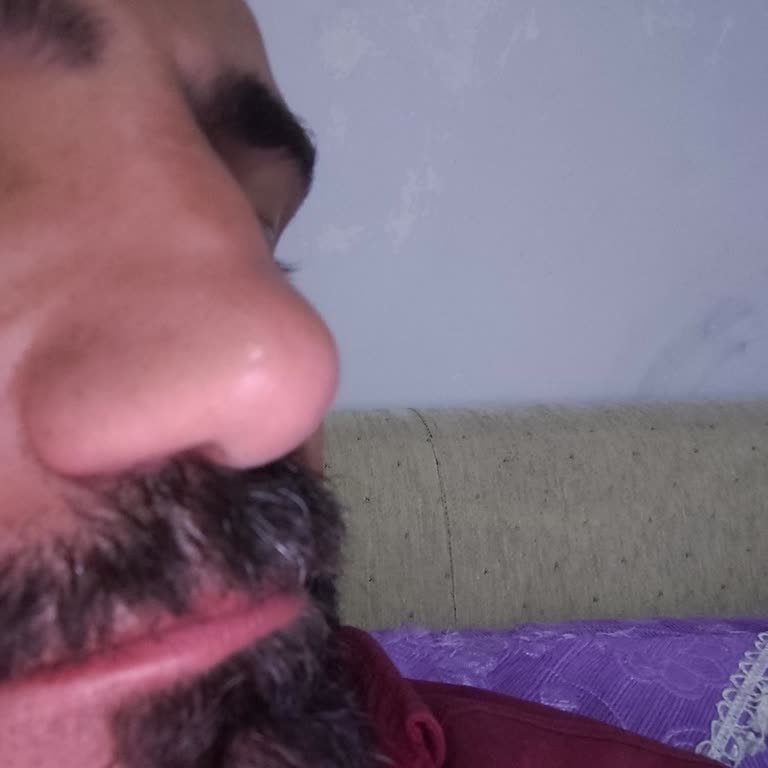 Başarısız Burun Estetiği Ve Süregelen Sorunlar