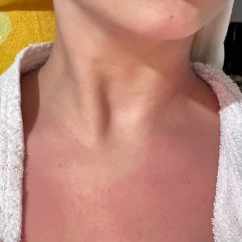 Sebamed Şampuanı İle Cilt Sorunları Yaşadım
