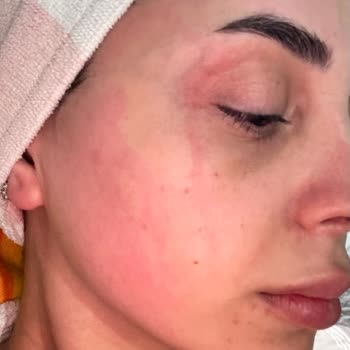 Sebamed Şampuanı İle Cilt Sorunları Yaşadım