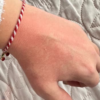 Sebamed Şampuanı İle Cilt Sorunları Yaşadım