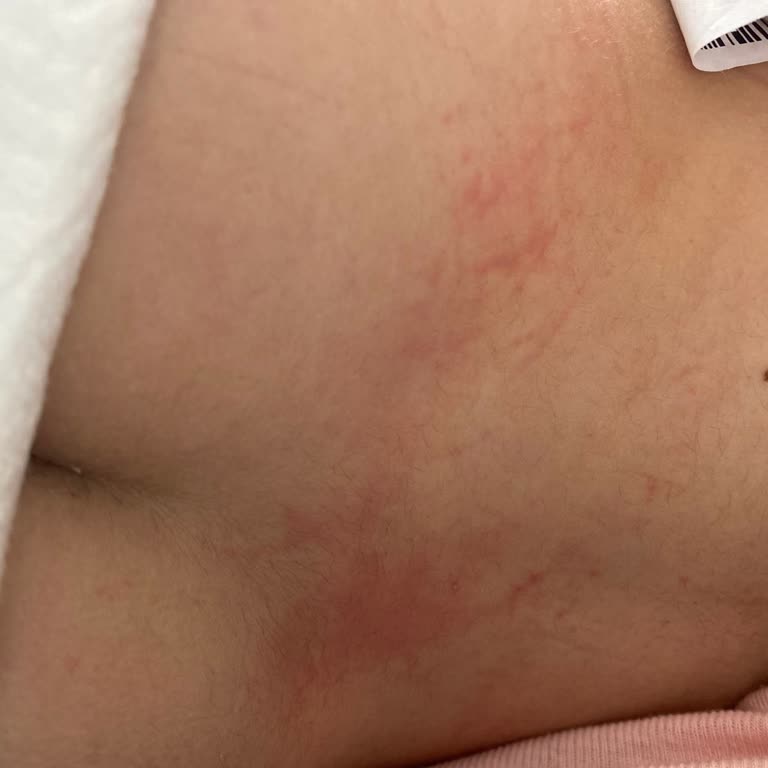 Bebek Bezinde Alerji Sorunu