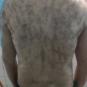 Lazer Tedavisinde Hayal Kırıklığı Ve Ek Ücret Talebi