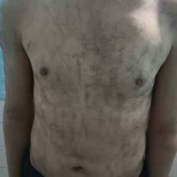 Lazer Tedavisinde Hayal Kırıklığı Ve Ek Ücret Talebi