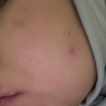 Yves Rocher Ürünleri Cildimde Sorun Yarattı