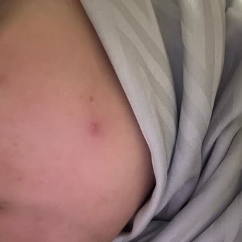 Yves Rocher Ürünleri Cildimde Sorun Yarattı