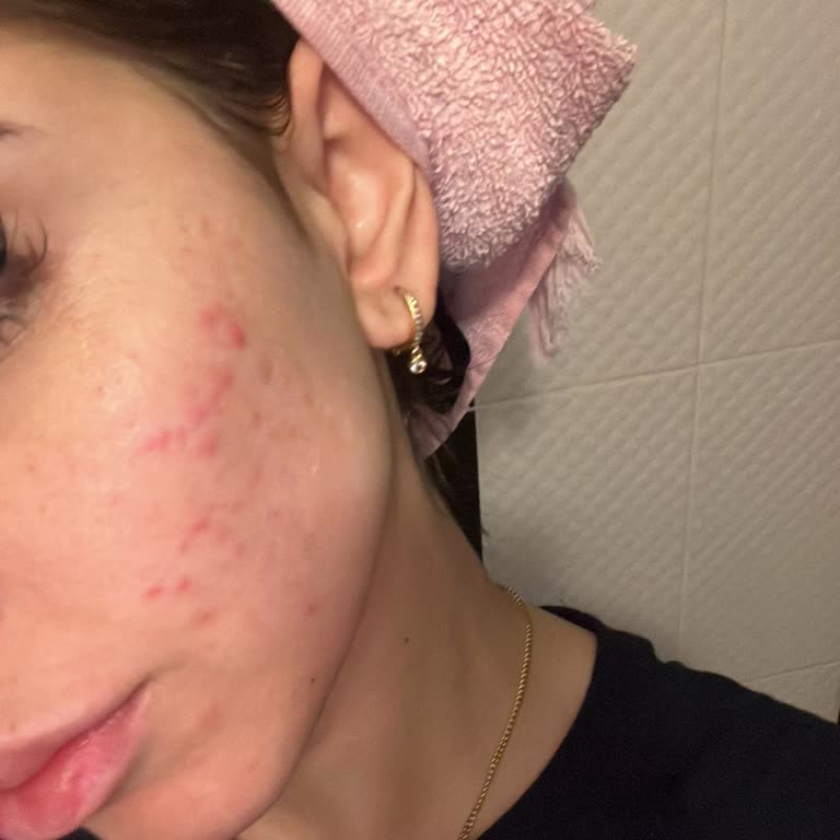 Ciltte Sivilce Sorunu Yaratan Primer Deneyimi