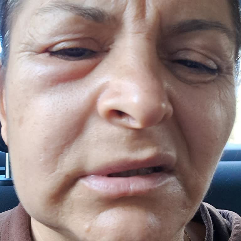 Yanlış Tedavi Mağduriyeti: Diş Ağrısı Ve Şişlik