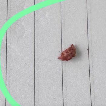 Diş Çekimi Sonrası Yaşanan Ağrı Ve İlgisizlik