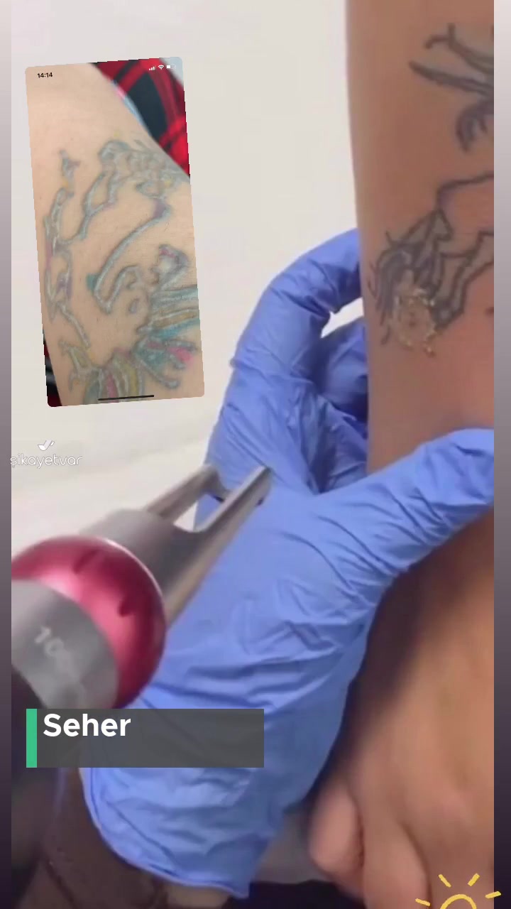 Çorum Jasmine Güzellik Merkezi Dövme Silmek Yerine Yakıyor! videonun kapak resmi