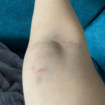 Lokman Hekim Hastaneleri  Damar Yolu Açma Kabusu