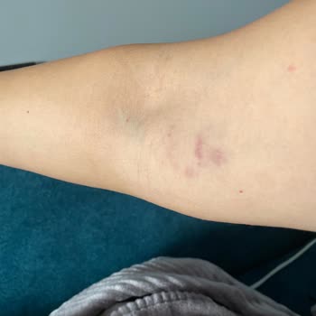 Lokman Hekim Hastaneleri  Damar Yolu Açma Kabusu