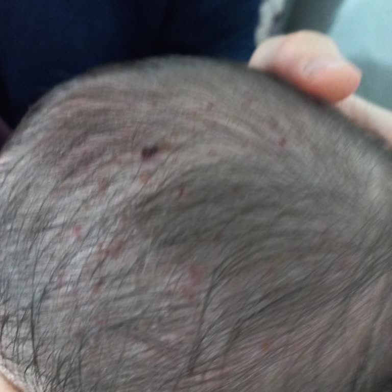 Bebekte Mustela Şampuanı İle Gelen Kaşıntı Krizleri
