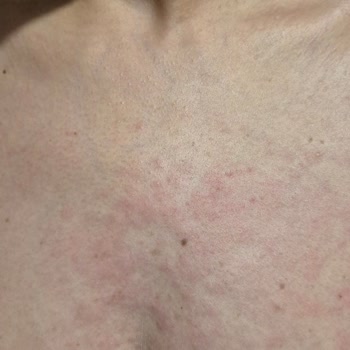 Alerji Yapan Ürünle İlgili Acil Yardım Talebi