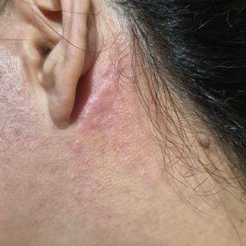 Alerji Yapan Ürünle İlgili Acil Yardım Talebi