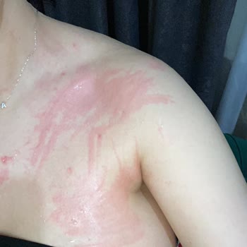 Ürün Alerji Yaptı Ve Sağlık Sorunlarına Yol Açtı
