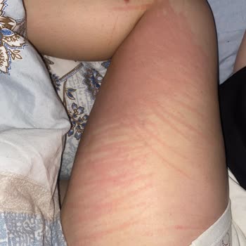 Ürün Alerji Yaptı Ve Sağlık Sorunlarına Yol Açtı