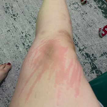 Ürün Alerji Yaptı Ve Sağlık Sorunlarına Yol Açtı