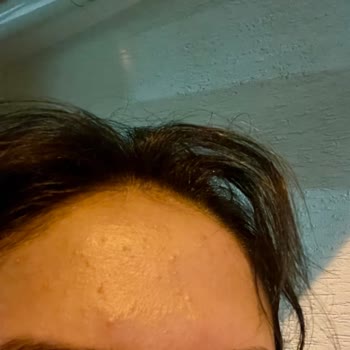 Bioderma Pigmentbio Jel Cildimde Sivilce Yaptı