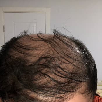 Saç Ekimi Hayal Kırıklığı: Beklentiler Karşılanmadı