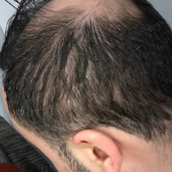 Saç Ekimi Hayal Kırıklığı: Beklentiler Karşılanmadı