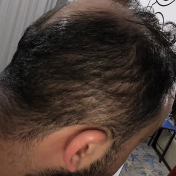 Saç Ekimi Hayal Kırıklığı: Beklentiler Karşılanmadı