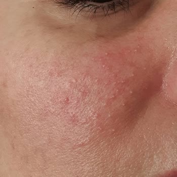 Clinique 72-Stunden Feuchtigkeitscreme Hautrötungen und Ausschläge nach Anwendung