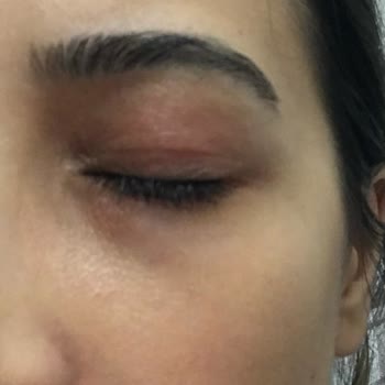 Clinique Moisture Surge & All About Eyes Rich Hautirritationen und Allergie nach Nutzung
