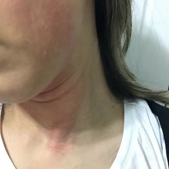 Clinique Moisture Surge & All About Eyes Rich Hautirritationen und Allergie nach Nutzung