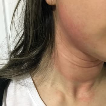 Clinique Moisture Surge & All About Eyes Rich Hautirritationen und Allergie nach Nutzung