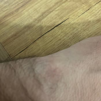 Watch 4 Kullanımı Sonrası Cilt Sorunları