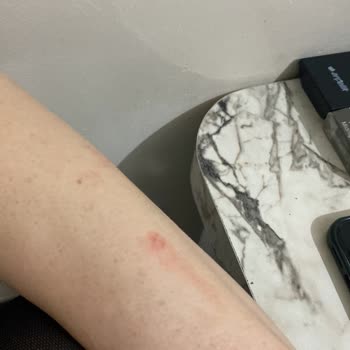 Sesu Ağda Kullanımı Sonrası Ciltte Yaralar Oluştu