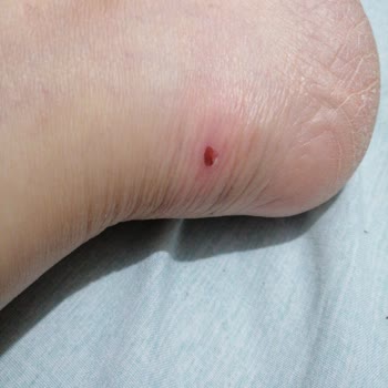 Polaris Ayakkabı Ayaklarımı Yara Etti