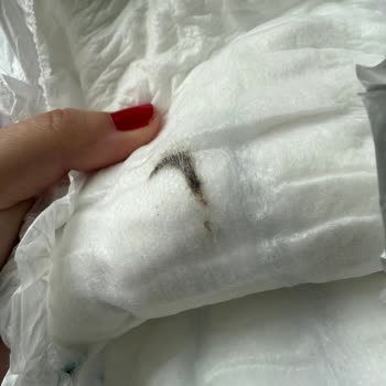 Bebek Bezinde Şok Edici Yabancı Madde