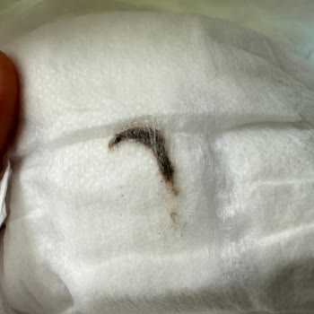 Bebek Bezinde Şok Edici Yabancı Madde