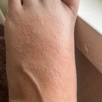 Alerji Yapan Ayakkabıya Çözüm Bulunamıyor