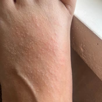 Alerji Yapan Ayakkabıya Çözüm Bulunamıyor