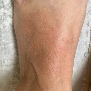 Alerji Yapan Ayakkabıya Çözüm Bulunamıyor